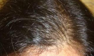 婴儿头发稀少怎么办